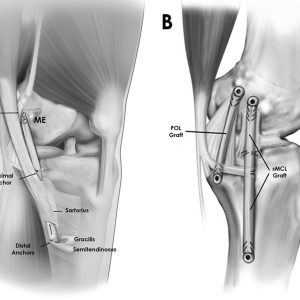 Multiligament-knee-Injury